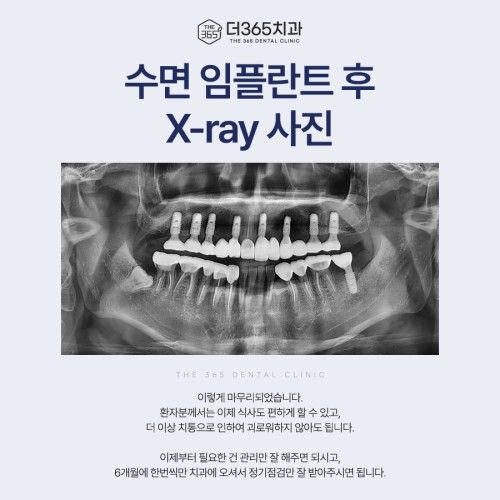 수면 임플란트 치료 후 촬영한 파노라마 X-ray 사진, 상하악 임플란트 식립 결과