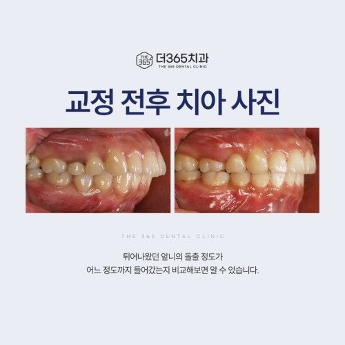 치아교정 전후 비교 사진, 돌출되었던 앞니가 교정 후 자연스럽게 들어간 결과