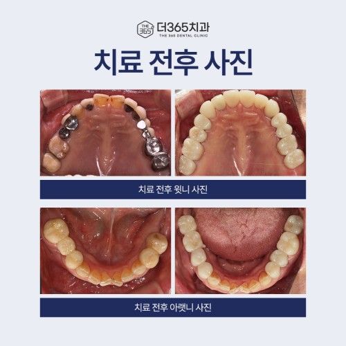 치료 전후 윗니, 아랫니 비교 사진 - 보철 치료를 통해 가지런하고 건강해진 치아 결과